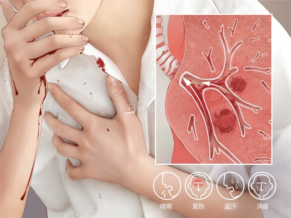 大咯血遇上肺栓塞,一个要止血,一个要通血,这怎么办?