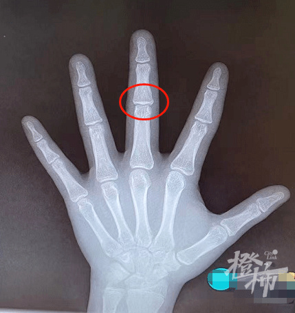 罗晓明|暑假“测骨龄”的娃乌泱泱！儿科专家提醒：要小心