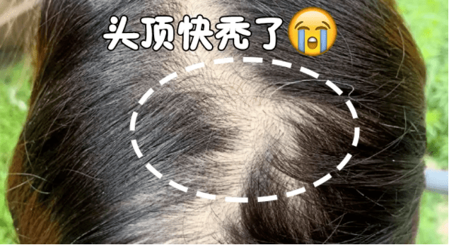 洗头|扁塌的「油头皮」竟能活过来！洗一次顶3次！发根蓬松，重拾发际线！