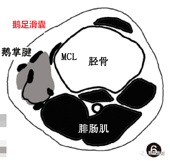 冈下肌滑囊图片