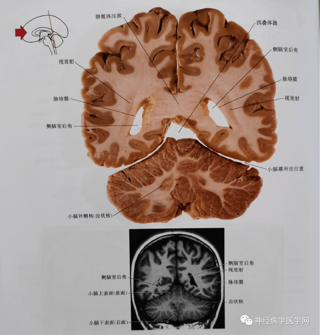 圖8 通過胼胝體壓部,四疊體池的尾部,側腦室三角區,小腦上腳,小腦中腳