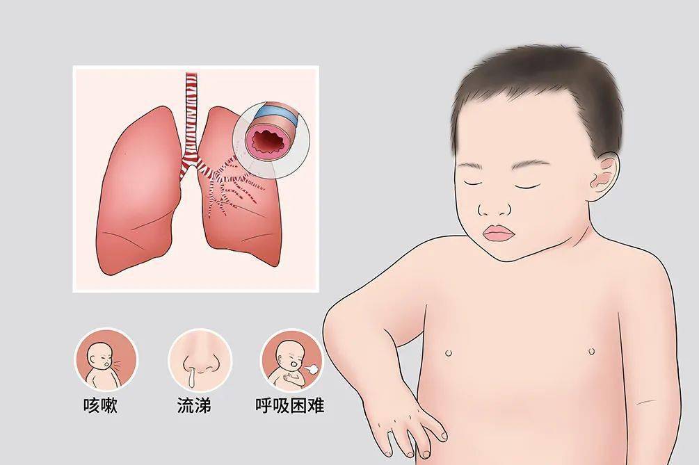 小儿毛细支气管炎是一种病毒感染引起的,以细支气管症状为主的下呼吸