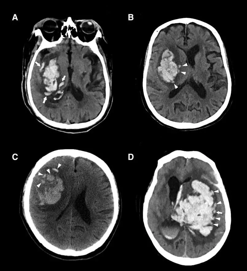 手把手教你怎麼判斷腦出血血腫擴大影像學徵象