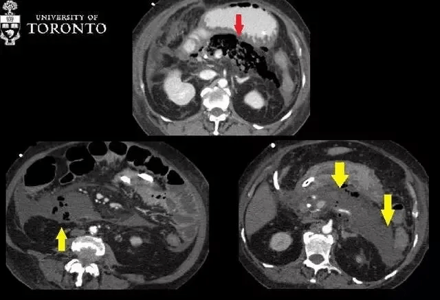 治疗|精选病例:典型的急性坏死性胰腺炎