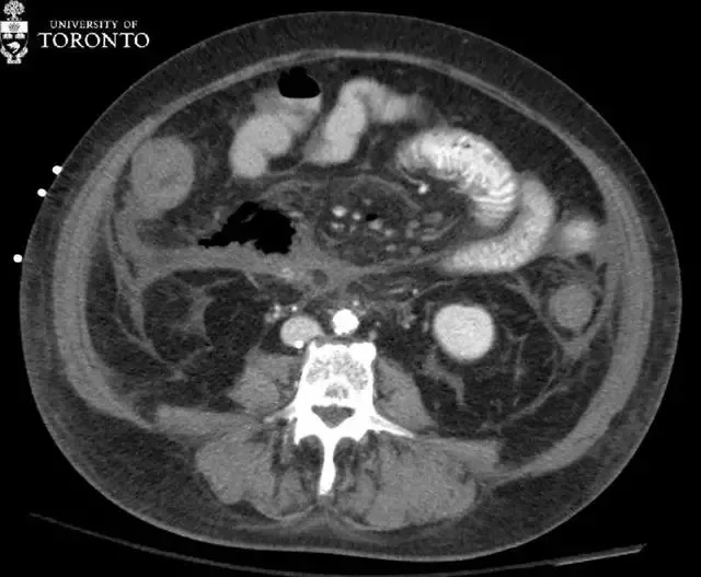 治疗|精选病例:典型的急性坏死性胰腺炎