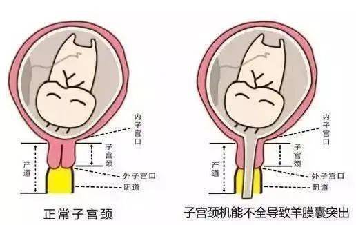 涇縣醫院上演胎兒保衛戰現場緊急進行宮頸環扎術