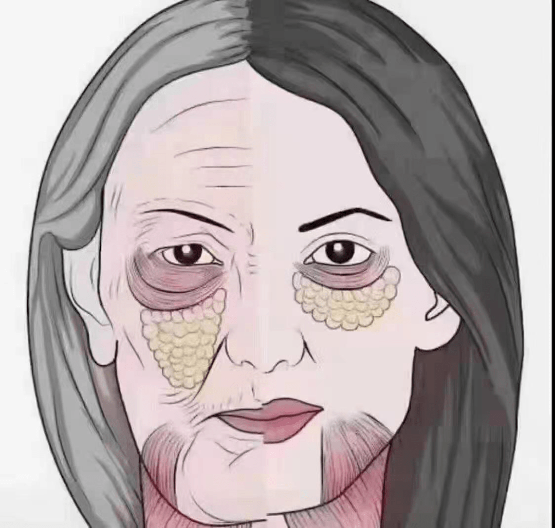 在变化从表皮层→真皮层→脂肪层→肌肉层→筋膜层→骨膜层面部衰老