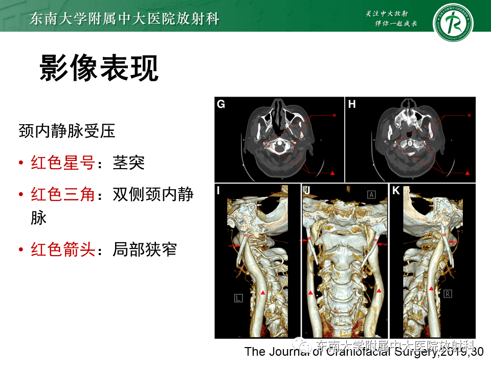 全面梳理:头颈部疾病——茎突综合征