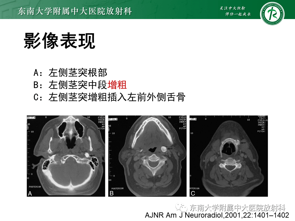 全面梳理:头颈部疾病——茎突综合征