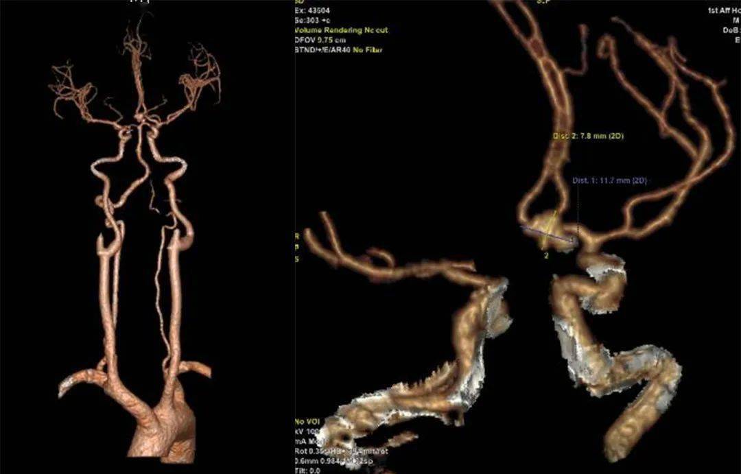 图1 入院后ct平扫提示前纵裂蛛网膜下腔出血cta提示:前交通动脉瘤.