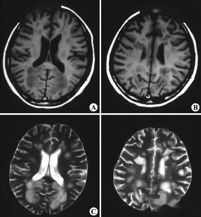 脑白质病变的影像学鉴别诊断
