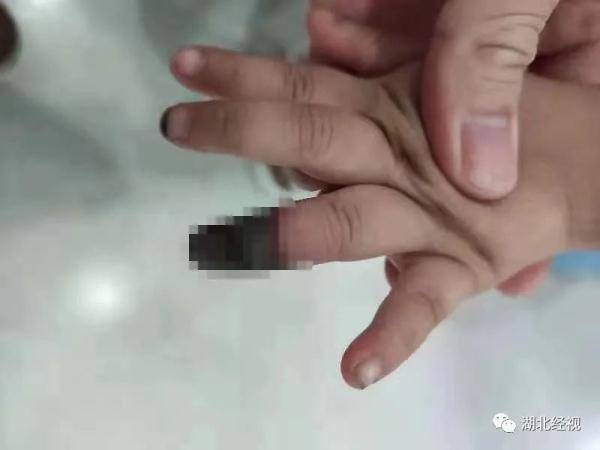 伤口|痛心！3岁女童小伤却被截掉手指！只因做错了这件事