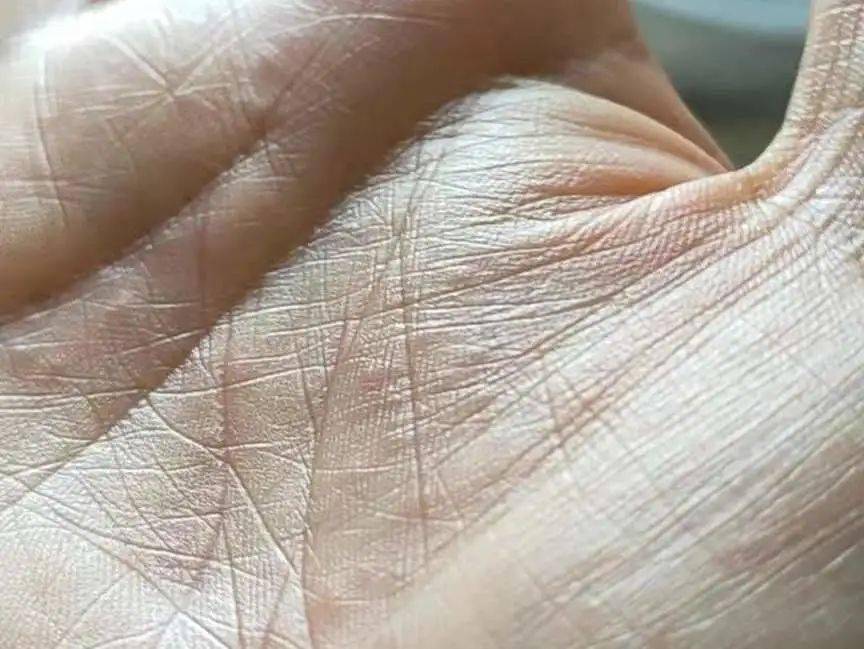 不然吓到了别人怎么办还好戴了手套她确笑着说看着手上长满的红色疹子