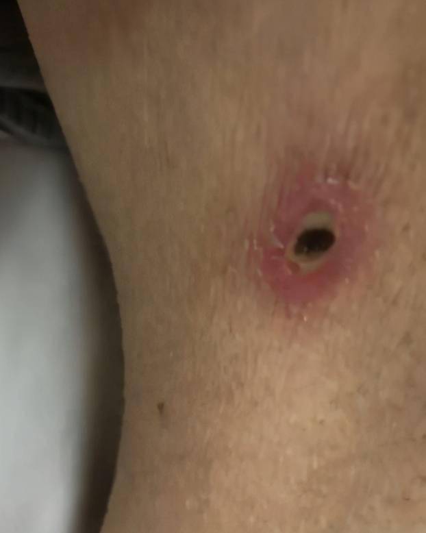 可怕江西一男子被小虫咬后多器官受损紧急抢救