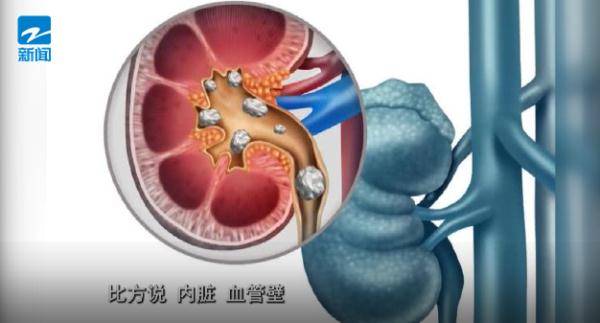 梭子蟹|梭子蟹加啤酒！浙江一男子半夜痛到怀疑人生，医生紧急提醒