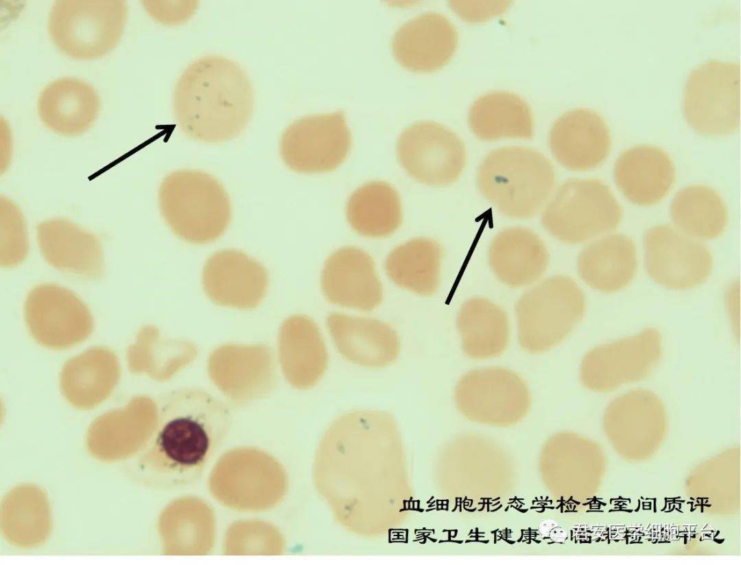 2021年第2次血细胞形态学检查室间质量评价_检验
