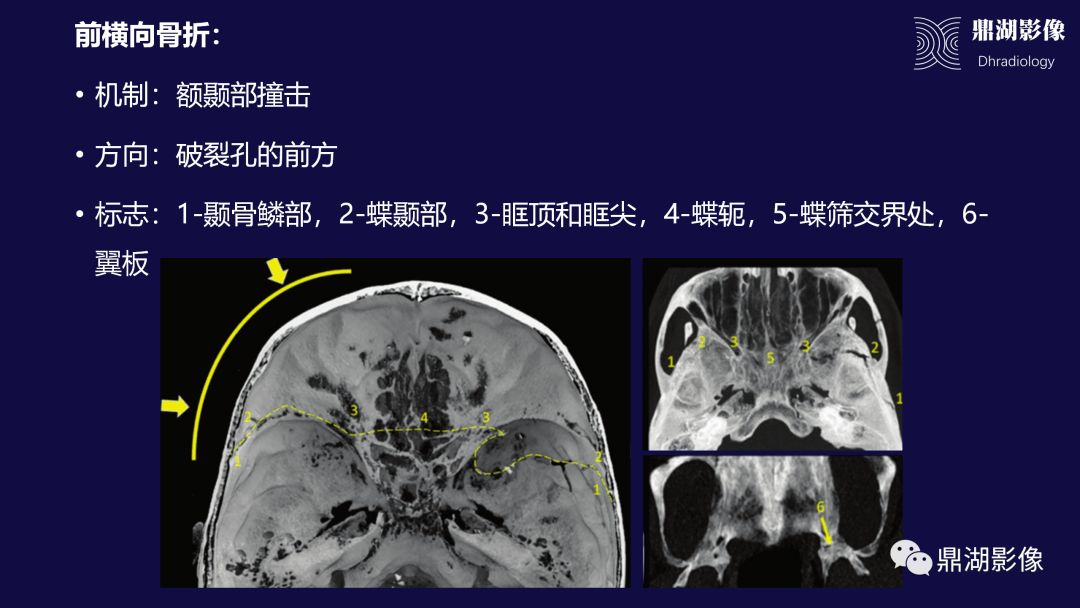 鼎湖精品 | 顱底骨折的分類及相關併發症_解剖