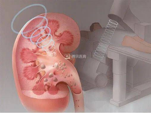 劉佳毅|從來沒痛過的結石，竟把我的腎臟搞壞了