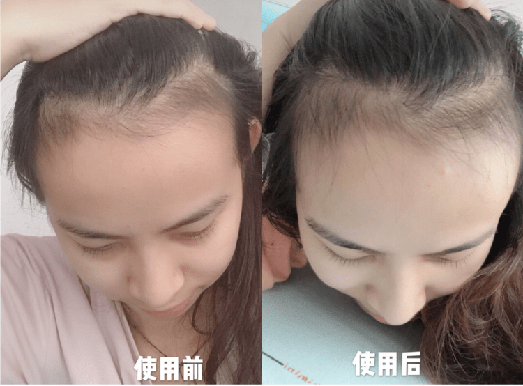洗头|脱发、秃头，又丑又显老！这样做，头发浓密，更显年轻好气质