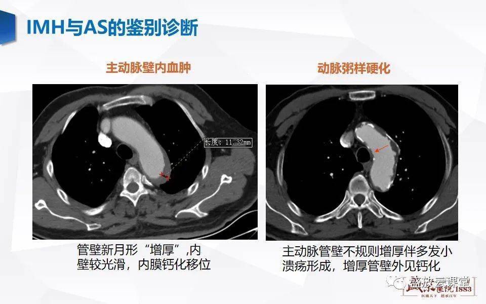 主动脉壁内血肿imh的影像诊断