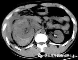 弹簧|图解21种腹部疼痛原因
