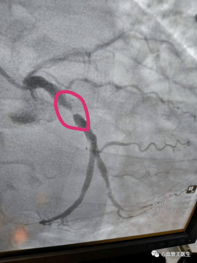 脖子发紧,医生说血管狭窄90%!造影证实!医生为啥判断这么准?
