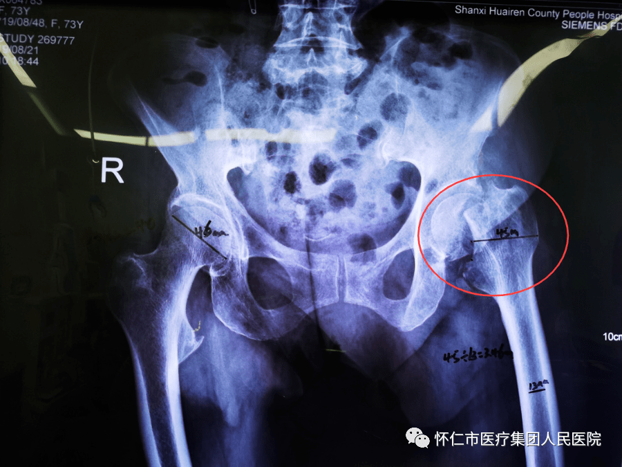 醫療動態懷仁人民醫院骨腦科成功為年近八旬老人進行人工股骨頭置換術