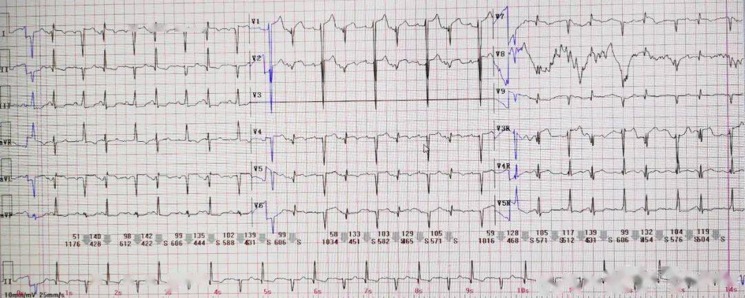 7份r波递增不良心电图你能全部识别吗