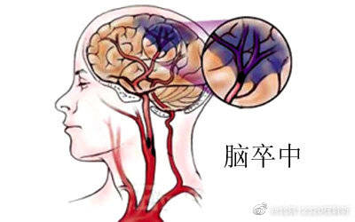 高发期|夏季导致脑中风发生的原因有哪些？