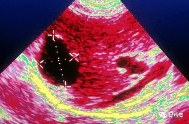 肝脏|体检发现“肝囊肿”怎么办？会不会变癌？要不要吃药？医生给你说清楚