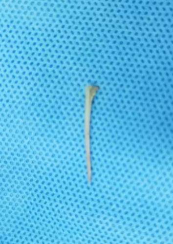 后壁|鱼刺卡喉用“老土方”？专家：不科学且危险！