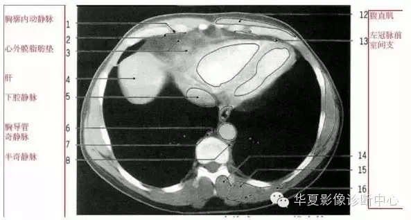 收藏超詳盡的心臟大血管影像示意圖及肺部解剖與影像分段
