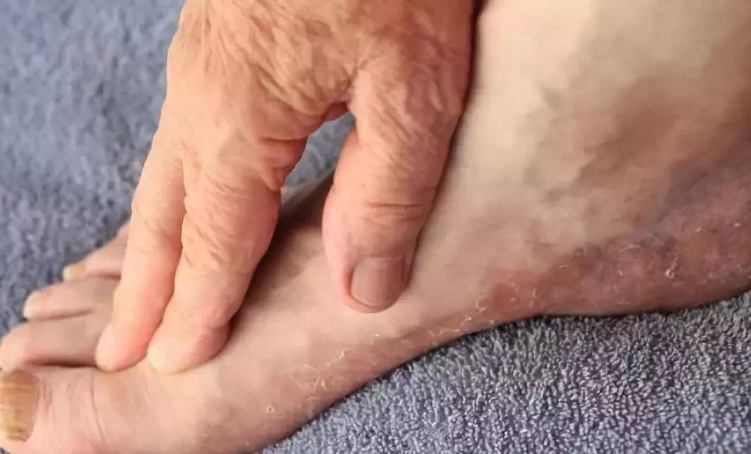 怎样快速有效治疗脚气 0de434c04aec4728bca48c859cebf8de.jpeg