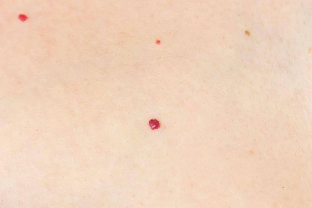 肝癌红痣图片 手臂图片