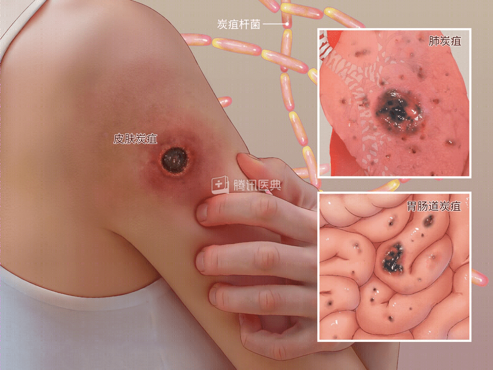 人感染皮肤炭疽病图片图片