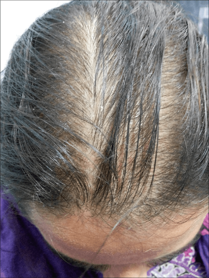 女性症状较轻,多头顶头发稀疏,前额发际线不后移(见下图).