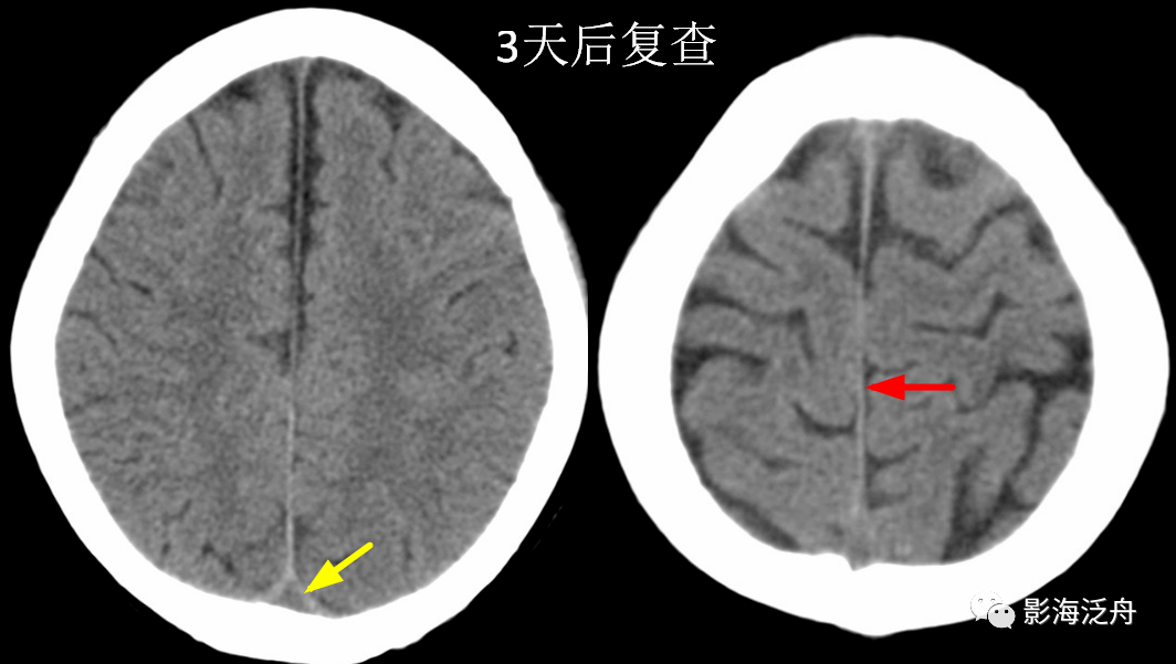 大脑镰旁急性硬膜下血肿与蛛网膜下腔出血的鉴别