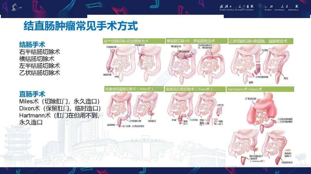 回肠造口还纳术ppt图片