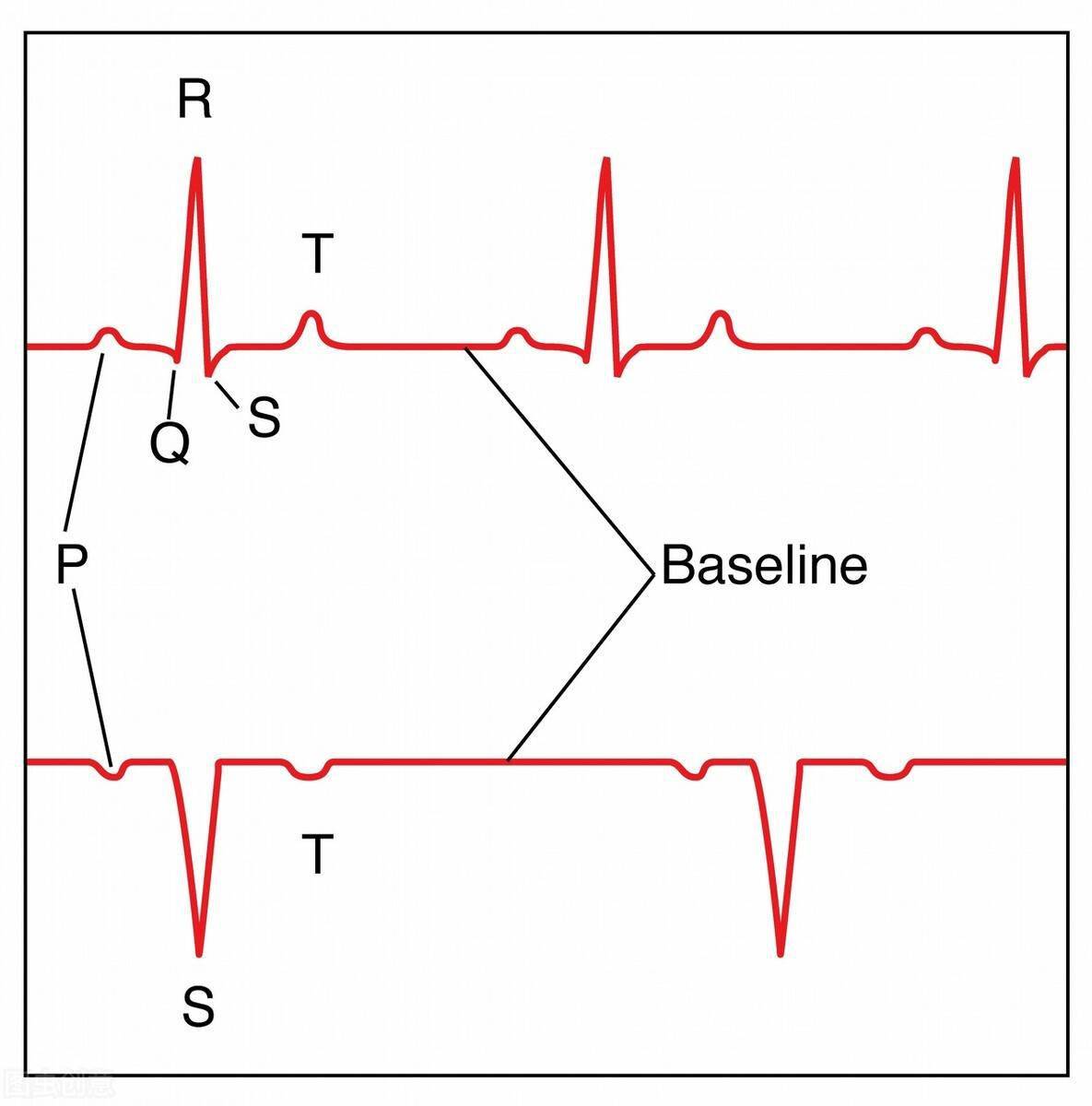 心电图写着窦性心律st段改变t波倒置是心脏病医生辟谣