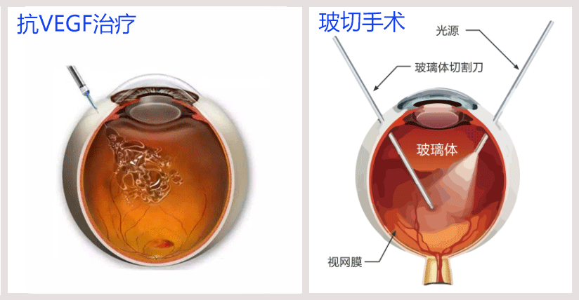 糖网致盲不可逆转早期筛查让失明风险降低九成