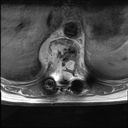 段长|脊柱多段长肿瘤业已压迫神经，中肿专家妙手拆弹抢救脊髓功能