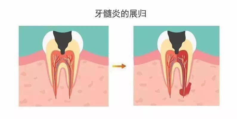 什麼是牙髓炎牙髓炎可以自愈嗎