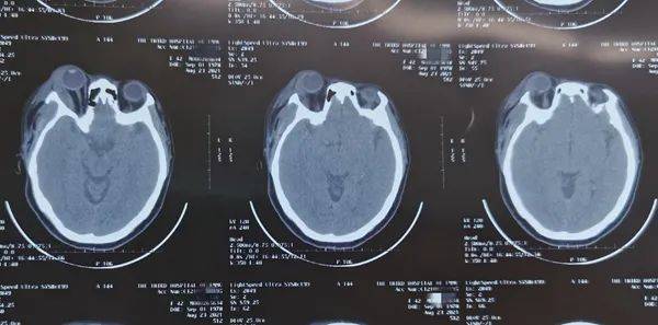 间隙|警惕！急性炎症期，拔牙需谨慎！