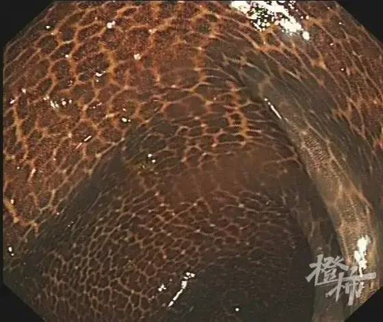 杜叶|热搜第一！吃了三年酵素，阿姨成“黑肠子”……医生：别乱吃