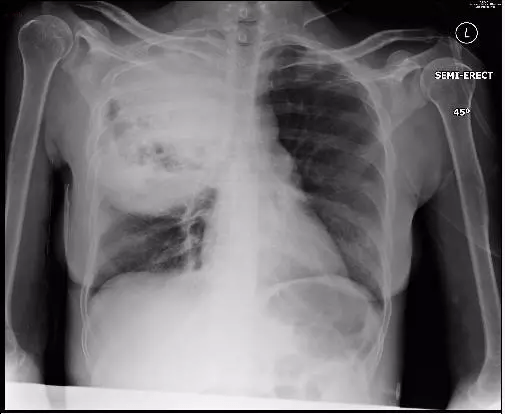 什么|教你从肺CT上分辨是哪种细菌感染丨肺炎克雷伯杆菌篇