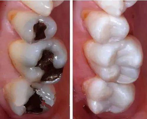 树脂充填临床常见问题及解决方法