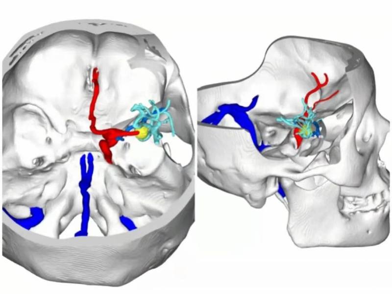 二医|高致死性脑动脉瘤破裂出血，3小时精准手术成功拆“炸弹”