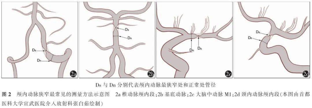 评价|最新共识 | 颅内动脉粥样硬化性狭窄影像学评价专家共识