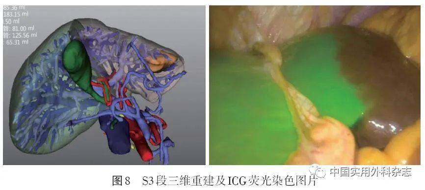 吲哚菁绿分子荧光影像技术诊断原发性肝癌与术中导航操作诊疗规范