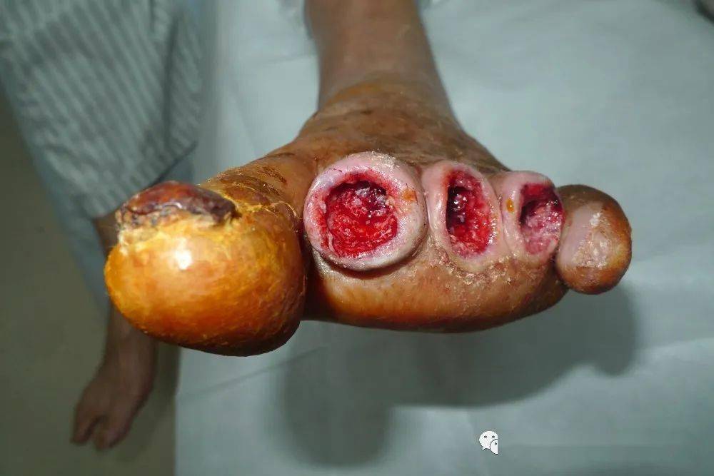 一例足趾发黑坏疽的糖尿病足治疗